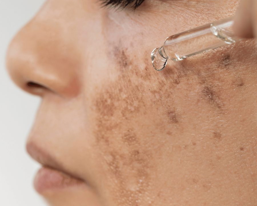 Topical Treatments for Melasma.png Best Skincare products for Melasma