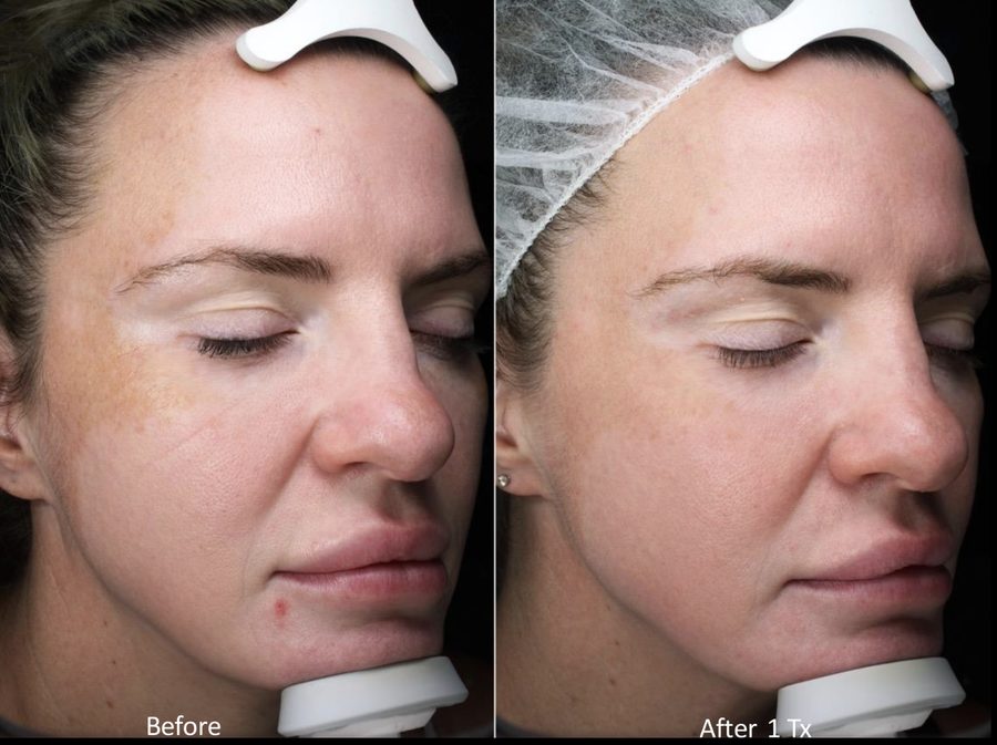 Melasma treatment with Moxi Moxi melasma treatment
