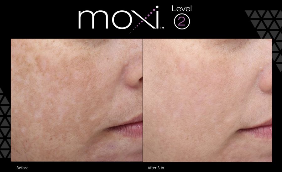 Moxi laser for Melasma Moxi treatment Melasma