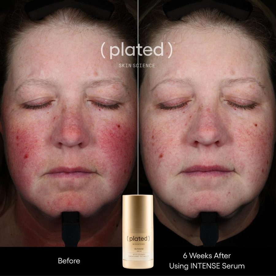Intense Results, Gentle Care B&A Intense Plated Exosomes Results