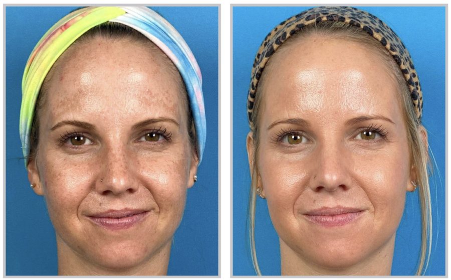 Halo Laser Before and After Before and After HALO