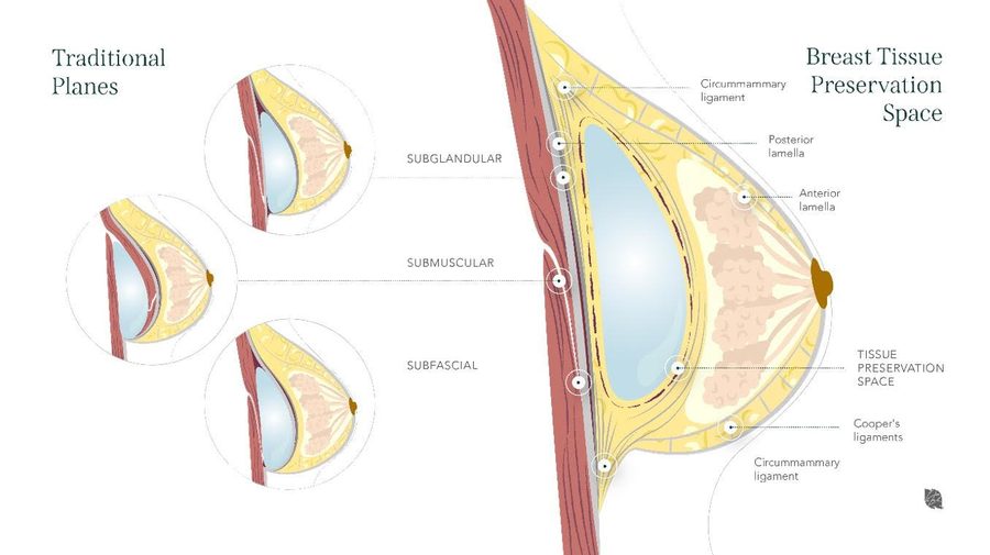 Motiva Preserve Implant Technology diagram Preservé Technique Comparison