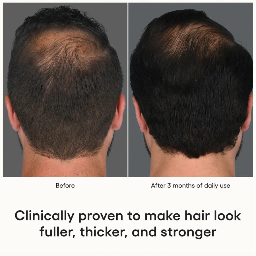 hair loss treatment for glp 1 patients and GLP-1 Medications GLP-1 Hair Loss & Muscle
