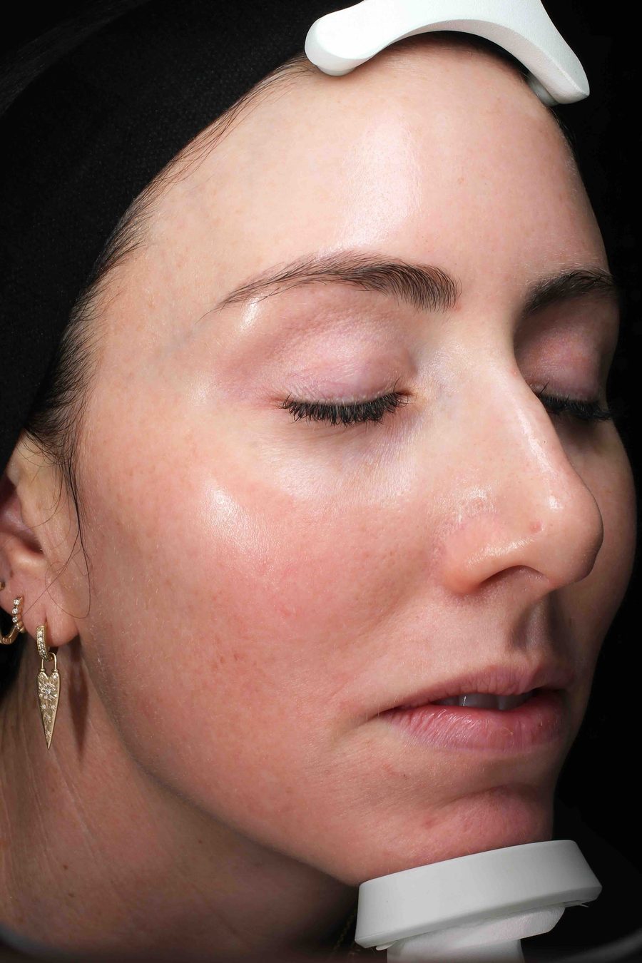 Close-up before and after results of 3 rounds of Sciton Moxi laser for melasma in Austin TX by Kari Van Zandt.