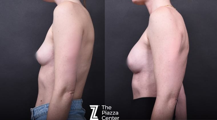 Motiva Preservé Implant  Before and After DrPiazza Austin